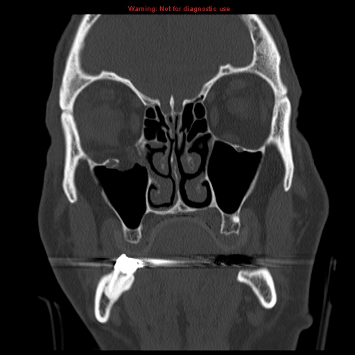 File:Blowout fracture with inferior rectus entrapment (Radiopaedia 12418-12673 Coronal bone window 7).jpg