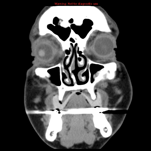 File:Blowout fracture with inferior rectus entrapment (Radiopaedia 12418-12673 Coronal non-contrast 2).jpg