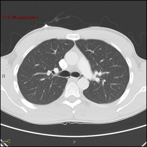 Blunt chest trauma - pulmonary interstitial emphysema and pneumomediastinum (Radiopaedia 20666-20552 Axial lung window 22).jpg