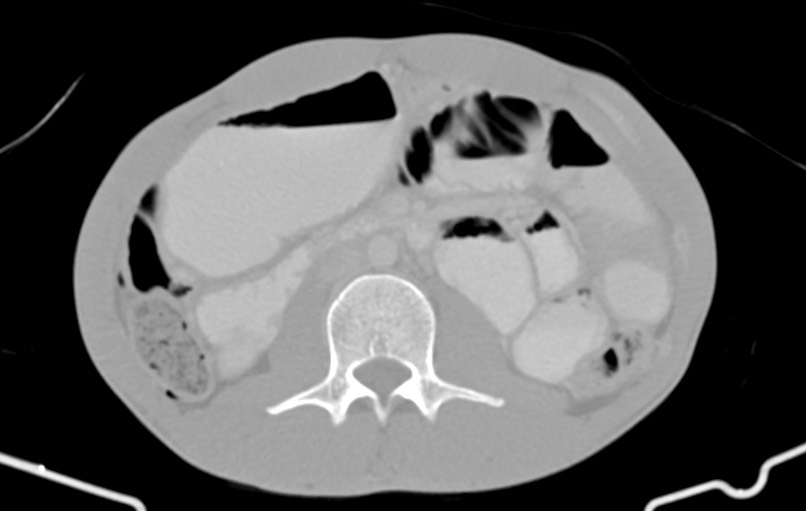 Blunt injury to the small bowel (Radiopaedia 74953-85987 Axial Wide 40).jpg