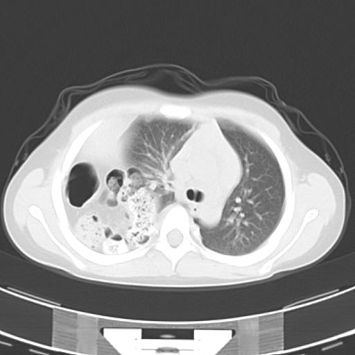 File:Bochdalek diaphragmatic hernia (Radiopaedia 38866-41059 Axial lung window 8).jpg