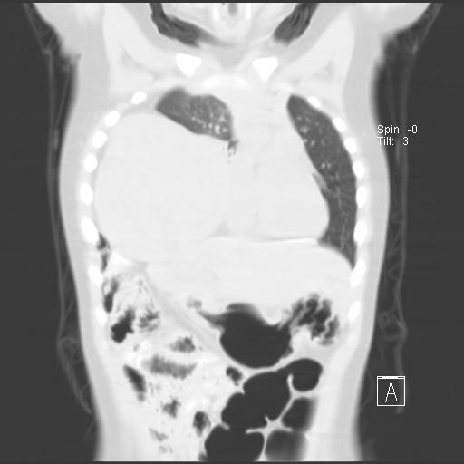 File:Bochdalek diaphragmatic hernia (Radiopaedia 38866-41059 Coronal lung window 7).jpg