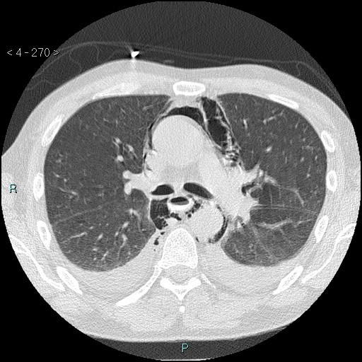 Boerhaave syndrome (Radiopaedia 27683-27897 lung window 25).jpg