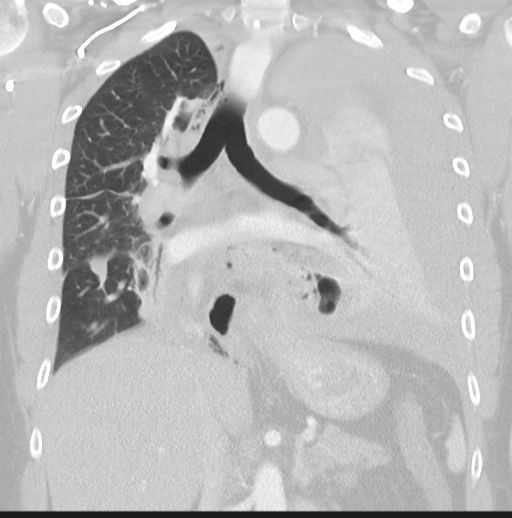 Boerhaave syndrome (Radiopaedia 39382-41661 Coronal lung window 27).png