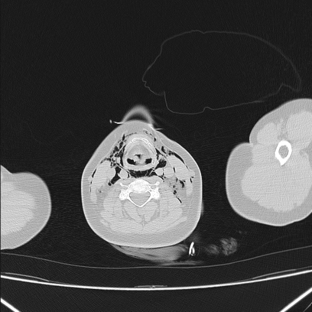 Boerhaave syndrome (Radiopaedia 45644-49799 Axial lung window 6).jpg