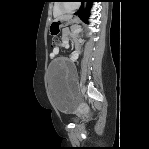 File:Borderline mucinous tumor (ovary) (Radiopaedia 78228-90808 B 41).jpg