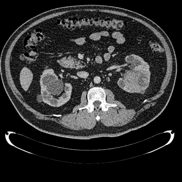 Bosniak renal cyst - type IV (Radiopaedia 24244-24518 C 149).jpg