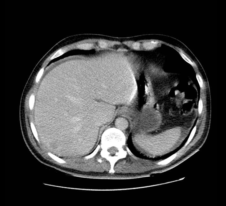 Bowel obstruction from colon carcinoma (Radiopaedia 22995-23028 A 14).jpg
