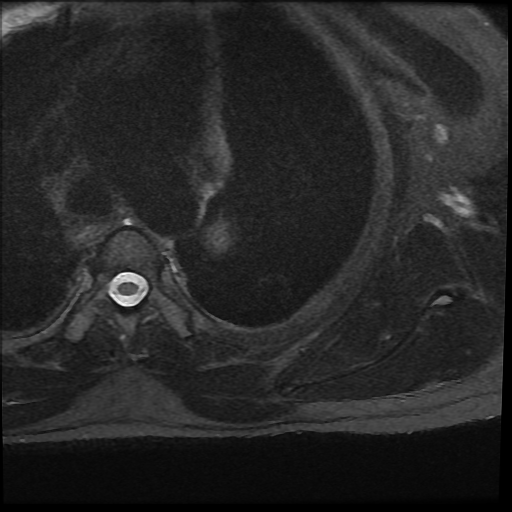 File:Brachial plexus neurofibroma (Radiopaedia 28030-28291 Axial T2 fat sat 1).png