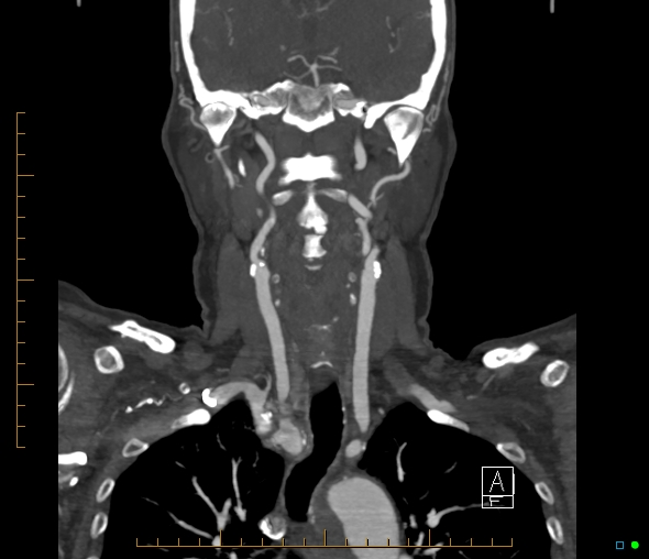 Brachiocephalic trunk stenosis (Radiopaedia 87242-103519 B 38).jpg