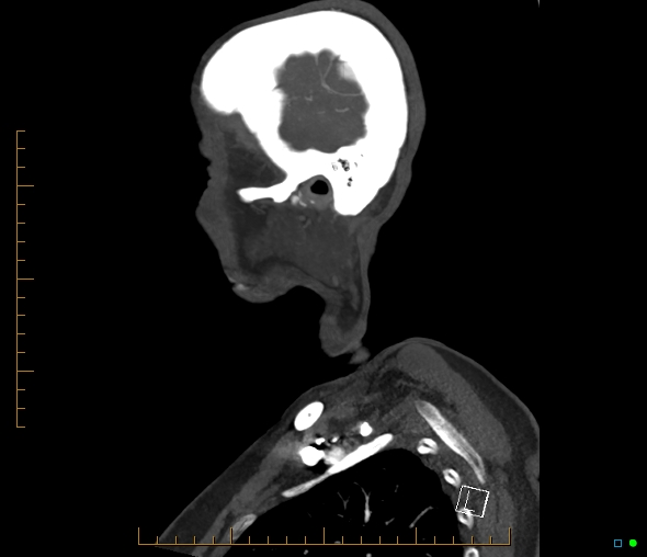 Brachiocephalic trunk stenosis (Radiopaedia 87242-103519 C 61).jpg