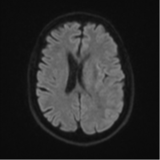 Brain metastasis (large cystic mass) (Radiopaedia 47497-52107 Axial DWI 45).png