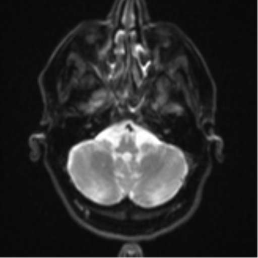 Brain metastasis (large cystic mass) (Radiopaedia 47497-52107 Axial DWI 5).png