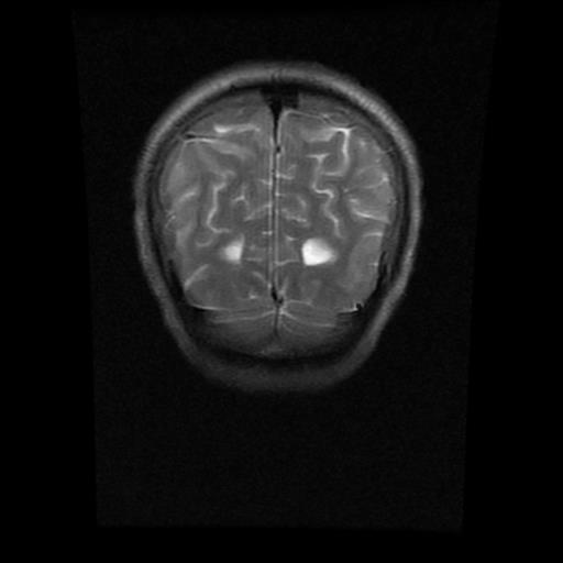 File:Brainstem glioma (Radiopaedia 30923-31624 Coronal T2 2).jpg