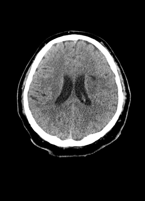Brainstem hemorrhage (Radiopaedia 81294-94976 Axial non-contrast 26).jpg