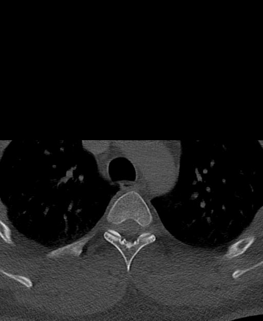 Branchial cleft cyst (Radiopaedia 31167-31875 Axial bone window 85).jpg