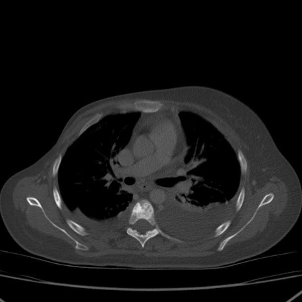 Breast cancer metastases - hepatic and skeletal (Radiopaedia 34201-35461 Axial bone window 18).jpg