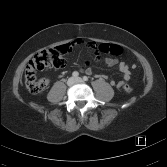 File:Breast metastases from renal cell cancer (Radiopaedia 79220-92225 C 69).jpg