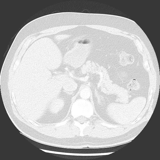 Bronchial carcinoid tumor (Radiopaedia 67377-76764 Axial lung window 63).jpg