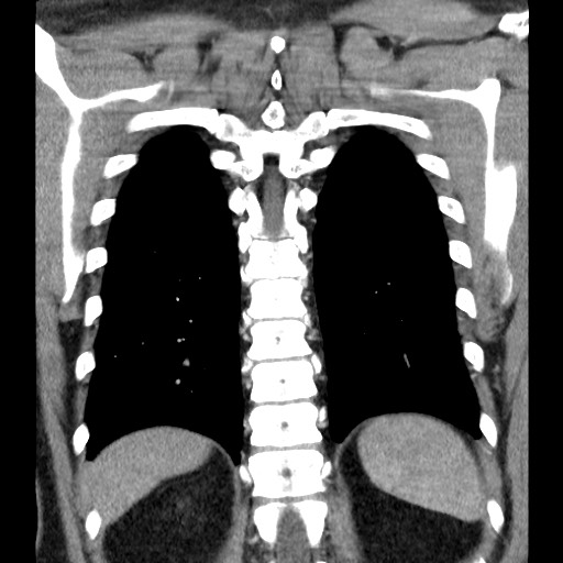 Bronchial carcinoid tumor (Radiopaedia 67377-76764 C 51).jpg