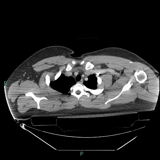 Bronchial carcinoid tumor (Radiopaedia 78272-90870 C 24).jpg