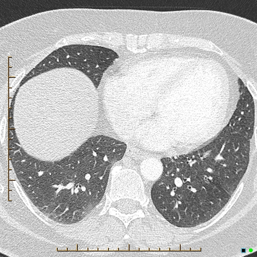 File:Bronchial diverticula (Radiopaedia 79512-92676 Axial lung window 144).jpg