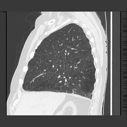 Bronchial stenosis - lung transplant (Radiopaedia 73133-83848 Sagittal lung window 22).jpg