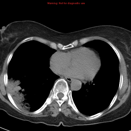 File:Bronchoalveolar carcinoma (BAC) (Radiopaedia 13436-13392 Axial non-contrast 34).jpg