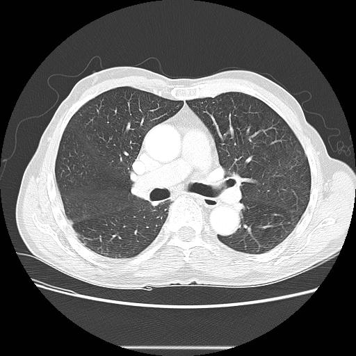 Bronchocele (Radiopaedia 17097-16795 Axial lung window 54).jpg