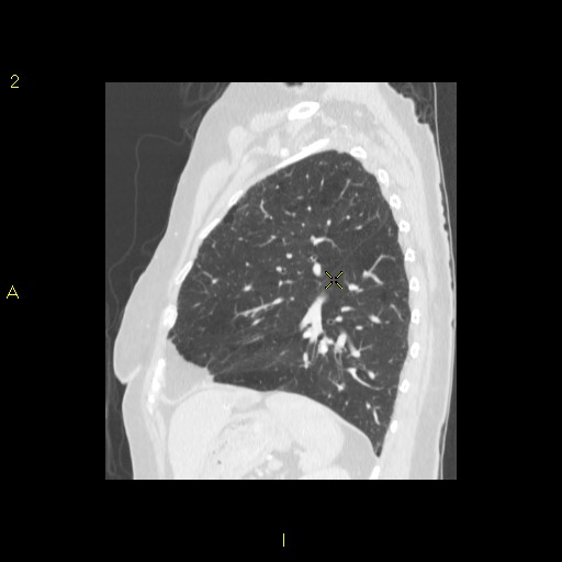 File:Bronchogenic carcinoma as an incidental finding (Radiopaedia 16453-16130 Sagittal lung window 16).jpg