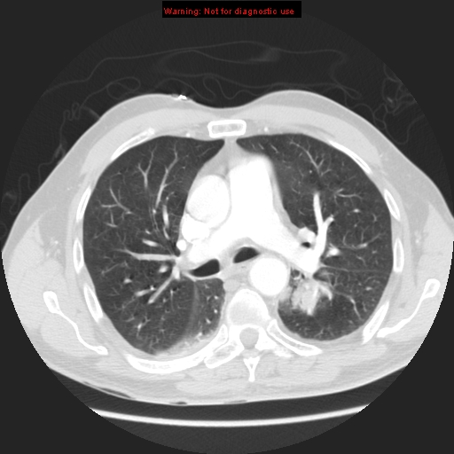 File:Bronchogenic carcinoma brain metastasis (Radiopaedia 9286-105832 Axial lung window 6).jpg