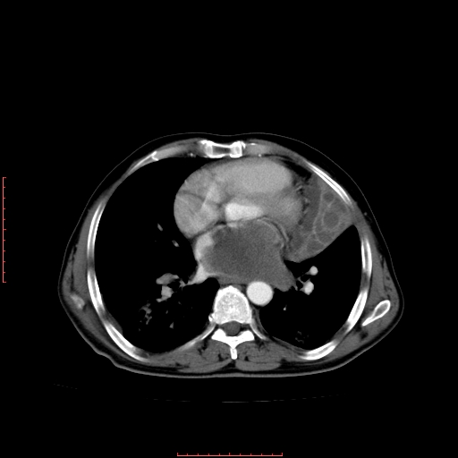 File:Bronchogenic carcinoma with left atrial large deposit - T4N3M1a (Radiopaedia 42316-45428 A 18).jpg