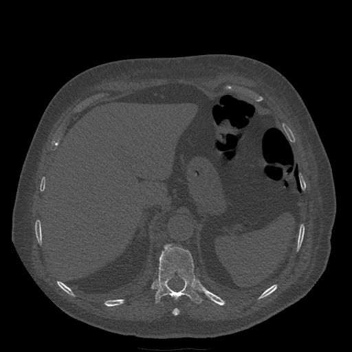 Bronchogenic carcinoma with metastatic lymphadenopathy (Radiopaedia 37671-39569 Axial bone window 51).jpg