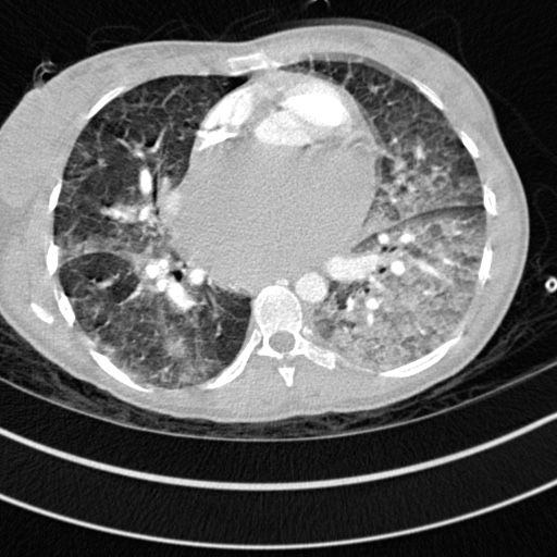 Bronchogenic cyst (Radiopaedia 77801-90071 Axial lung window 44).jpg