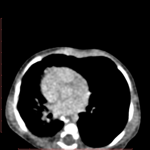 Bronchogenic cyst (Radiopaedia 78599-91409 B 116).jpg
