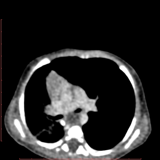 Bronchogenic cyst (Radiopaedia 78599-91409 B 94).jpg