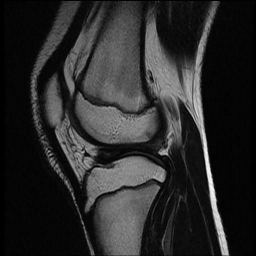 File:Bucket handle tear - lateral meniscus (Radiopaedia 72124-82634 Sagittal T2 6).jpg