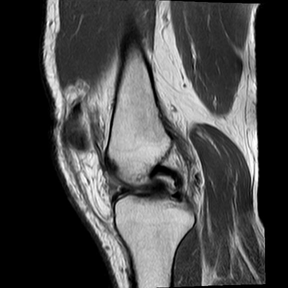 File:Bucket handle tear - medial meniscus (Radiopaedia 29250-29664 Sagittal PD 13).jpg
