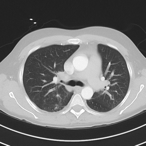 Burkitt lymphoma (Radiopaedia 34686-36121 Axial lung window 20).png