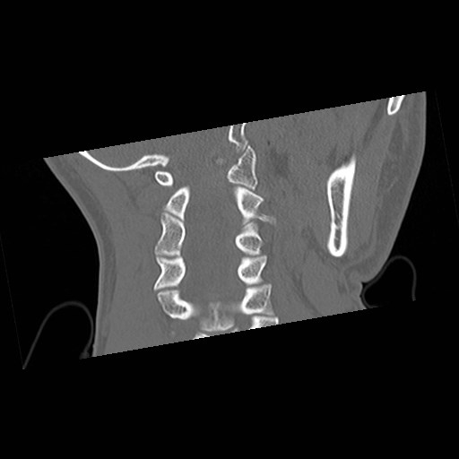 C1-C2 "subluxation" - normal cervical anatomy at maximum head rotation (Radiopaedia 42483-45607 Coronal non-contrast 29).jpg