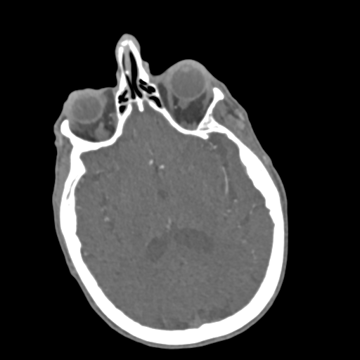 C2 fracture with vertebral artery dissection (Radiopaedia 37378-39200 A 249).png