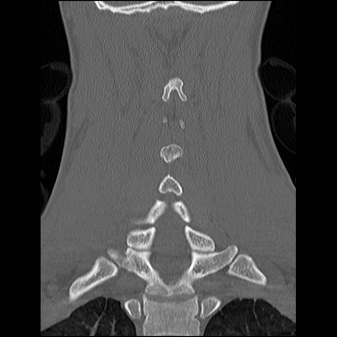 C5 facet fracture (Radiopaedia 58374-65499 Coronal bone window 41).jpg