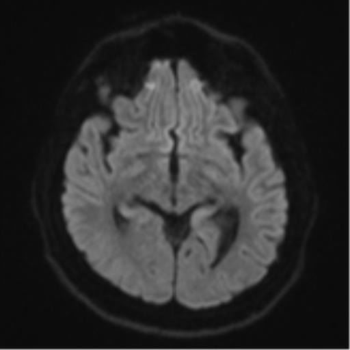 File:CNS vasculitis (Radiopaedia 55715-62263 Axial DWI 42).png