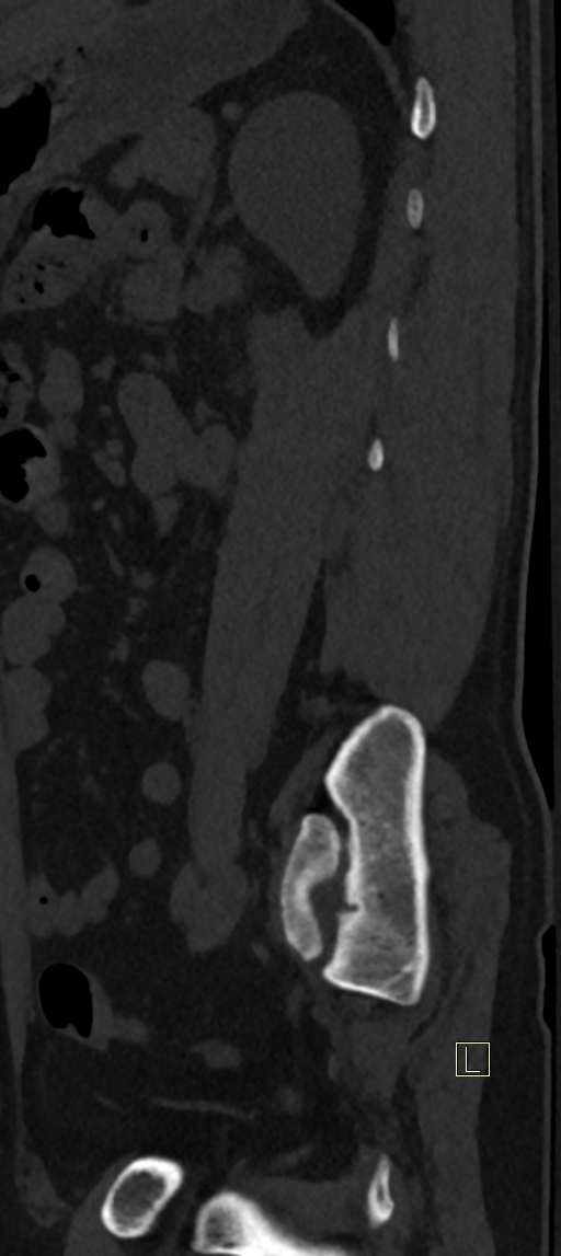 Calcaneal fractures with associated L2 burst fracture (Radiopaedia 71671-82493 Sagittal bone window 5).jpg