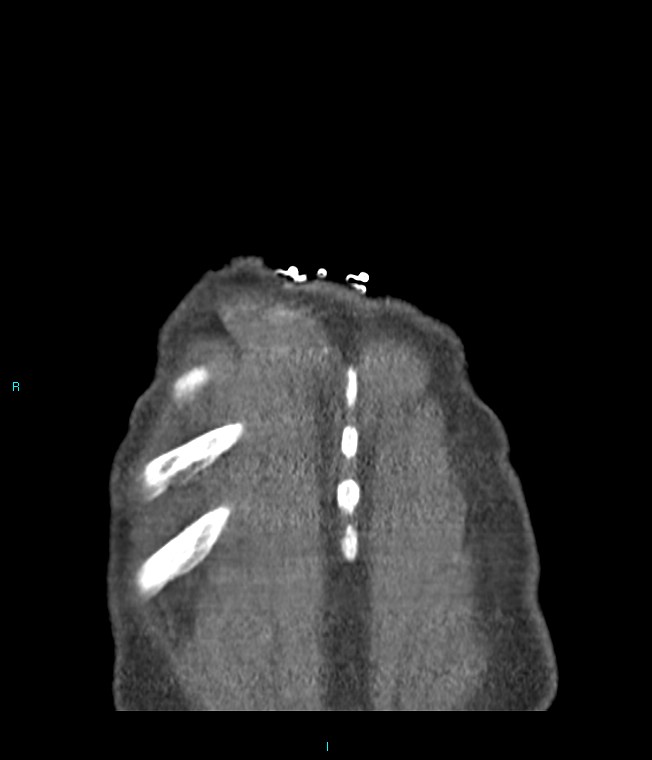 Calcified cerebral emboli from left ventricular thrombus (Radiopaedia 84420-99760 Coronal C+ CTPA 4).jpg