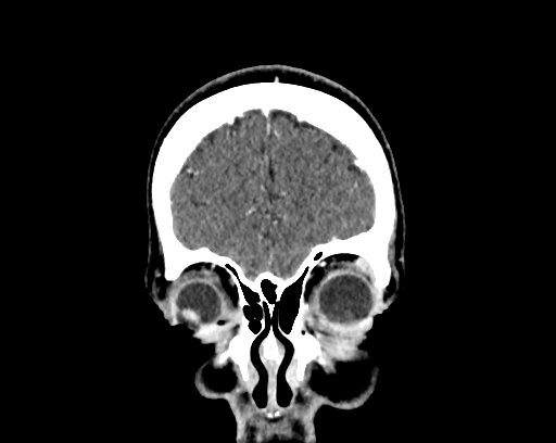 Calcified cerebral hydatid cyst (Radiopaedia 65603-74717 C 6).jpg