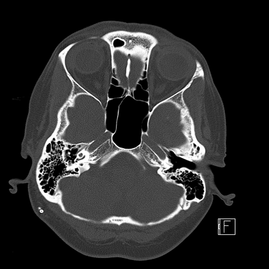 Calcified chronic subdural hematoma (Radiopaedia 77374-89492 Axial bone window 25).jpg