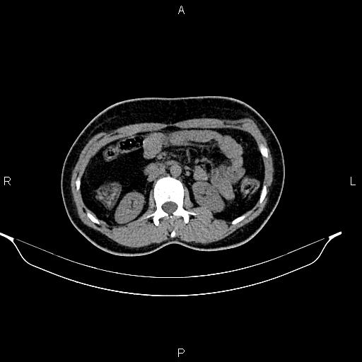 File:Calcified hepatic hydatid cyst (Radiopaedia 84672-100095 Axial non-contrast 46).jpg