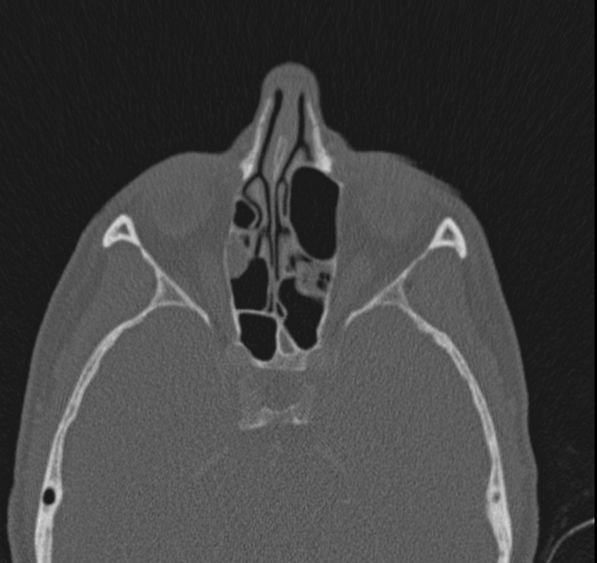 Caldwell-Luc operation (Radiopaedia 52329-58225 Axial bone window 25).jpg