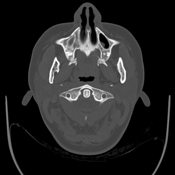 Calvarial osteoma (Radiopaedia 36520-38079 Axial bone window 2).jpg